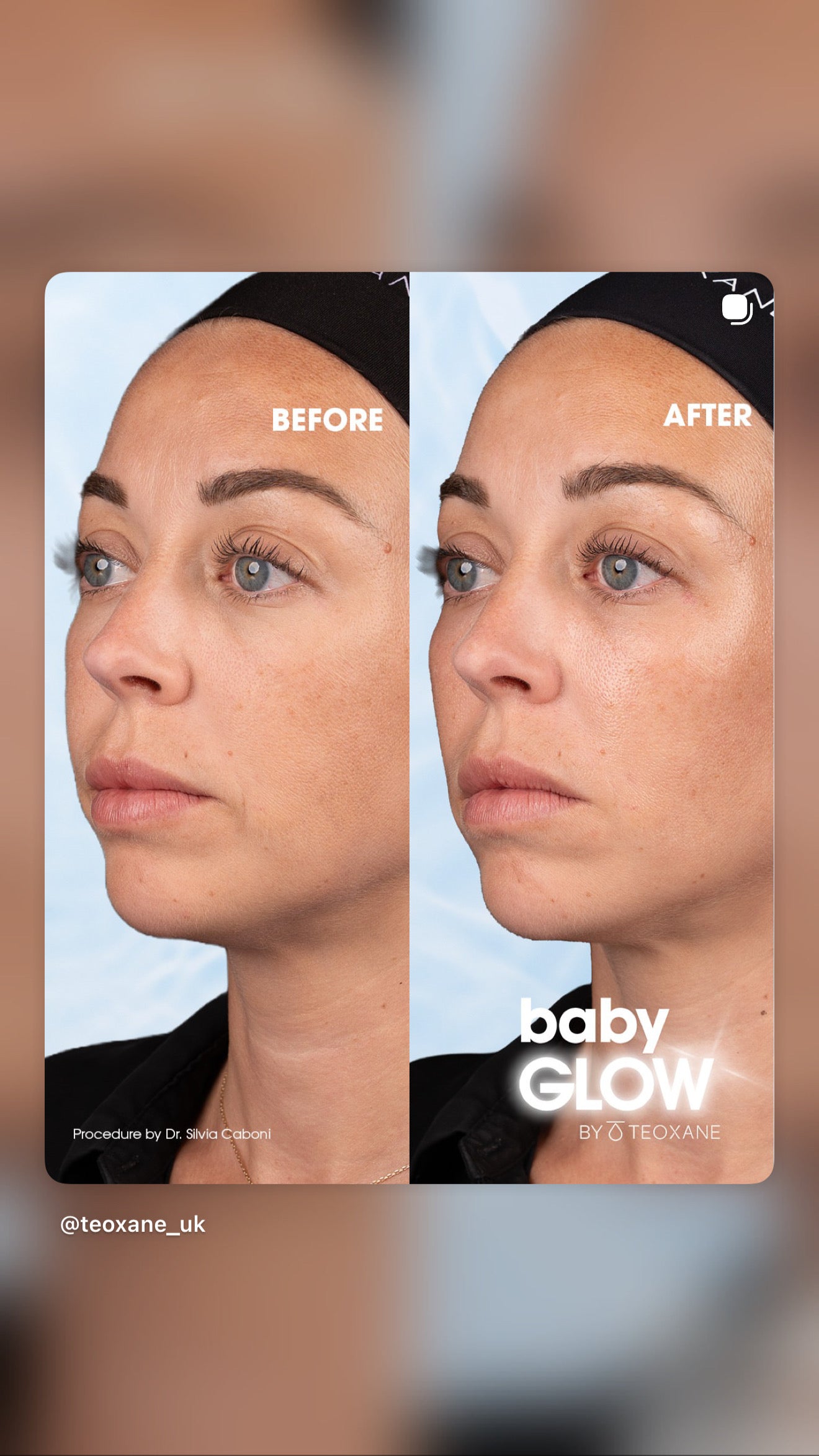 Teoxane babyGLOW™ 治疗前后对比，斜侧面视角（官方图片，其他诊所案例，非 My Timeless 效果）