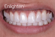 Enlighten Natural B1 Teeth Whitening