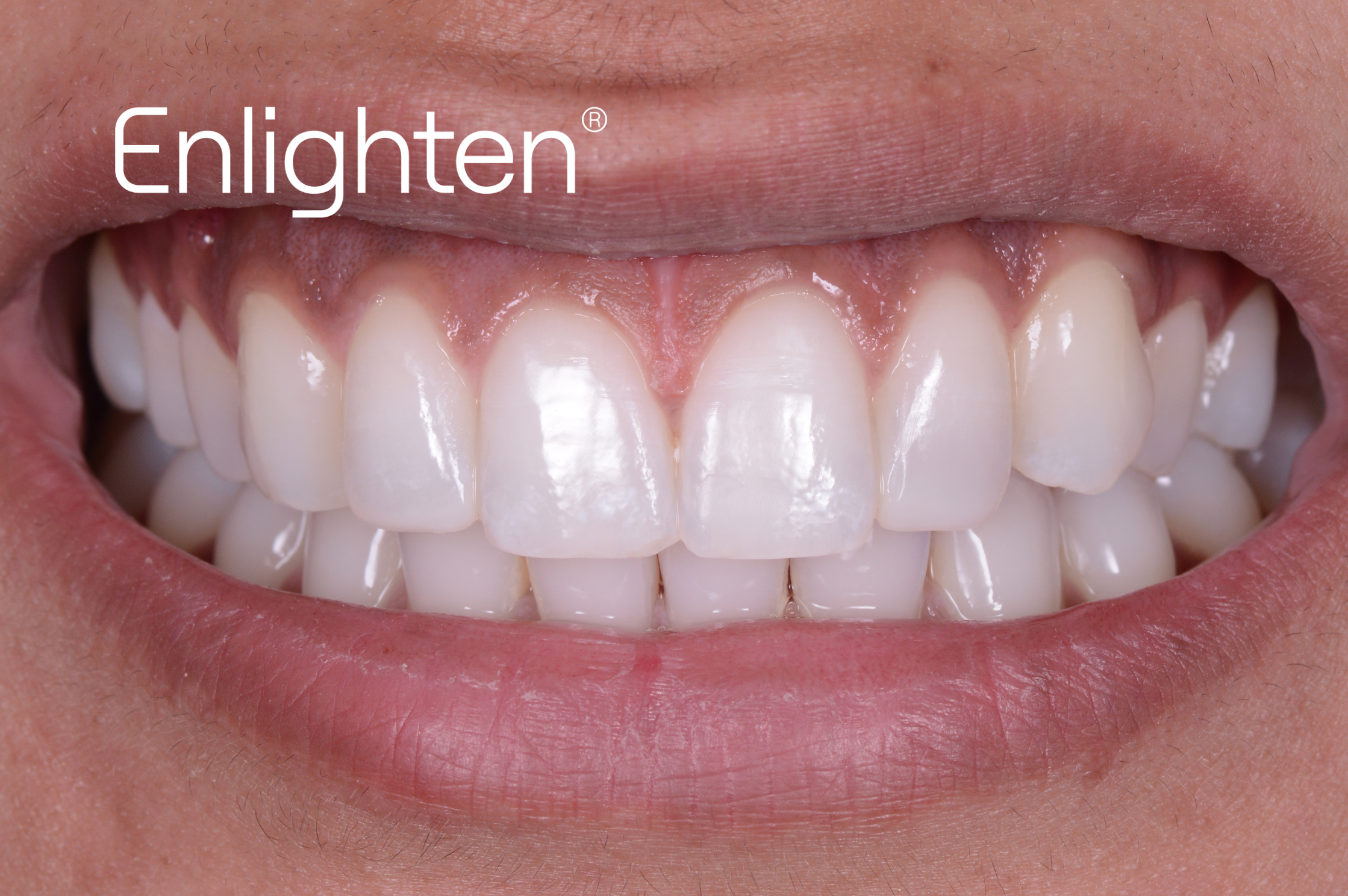 Enlighten Natural B1 Teeth Whitening