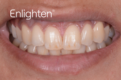 Enlighten Natural B1 Teeth Whitening
