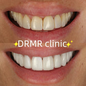 Ultra-Natural Full Mouth Porcelain Veneers