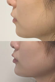 Dermal filler(Juvederm) - MY TIMELESS
