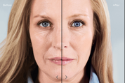 Sculptra® 童颜针治疗前后对比（半脸对比图）