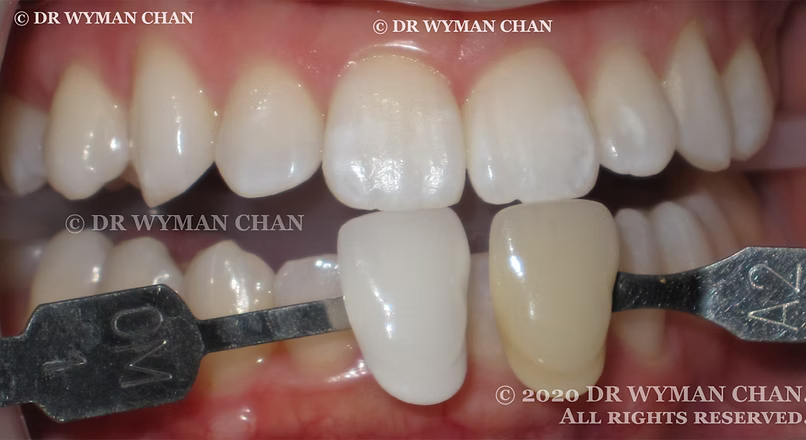 Hollywood Zero-Sensitivity Teeth Whitening