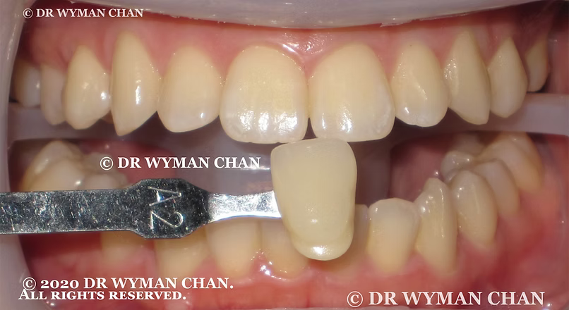 Hollywood Zero-Sensitivity Teeth Whitening