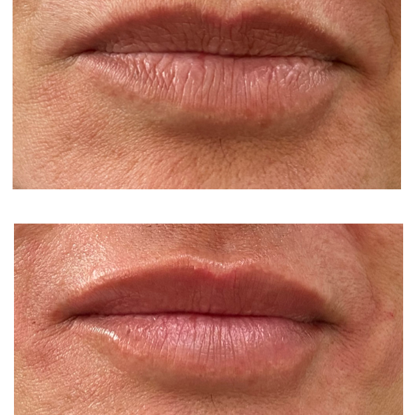 Lip enhancement - MY TIMELESS