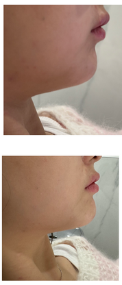 Dermal filler(Juvederm) - MY TIMELESS