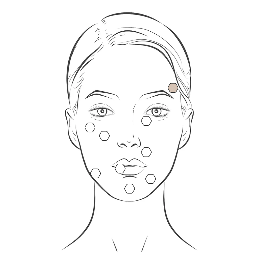 Dermal filler(Juvederm) - MY TIMELESS