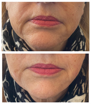 Dermal filler(Juvederm) - MY TIMELESS