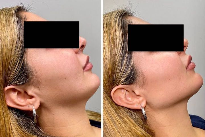 Jawline lifting/Nefertiti lifting - MY TIMELESS