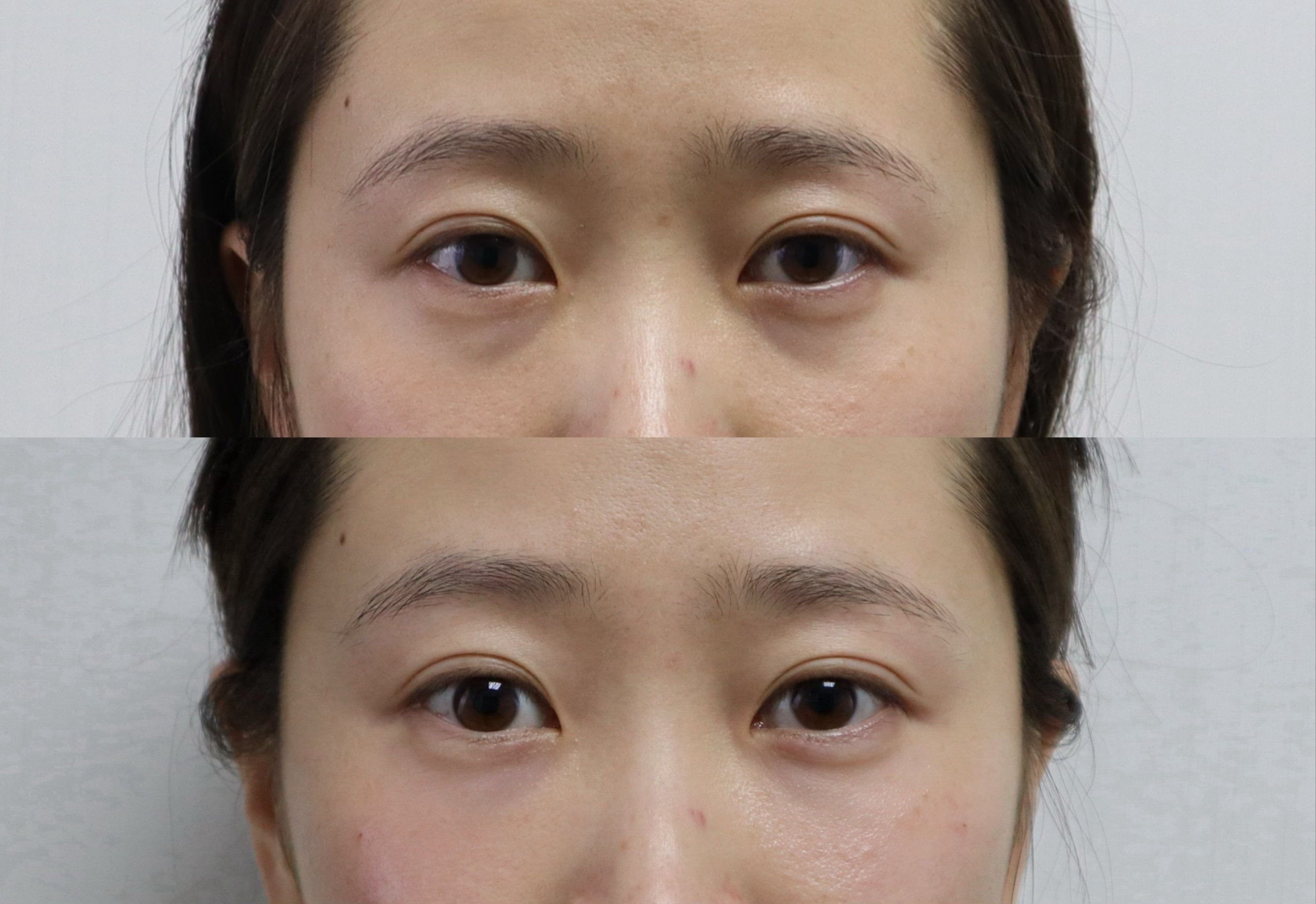 Tear trough rejuvenation(Teoxyal II) - MY TIMELESS