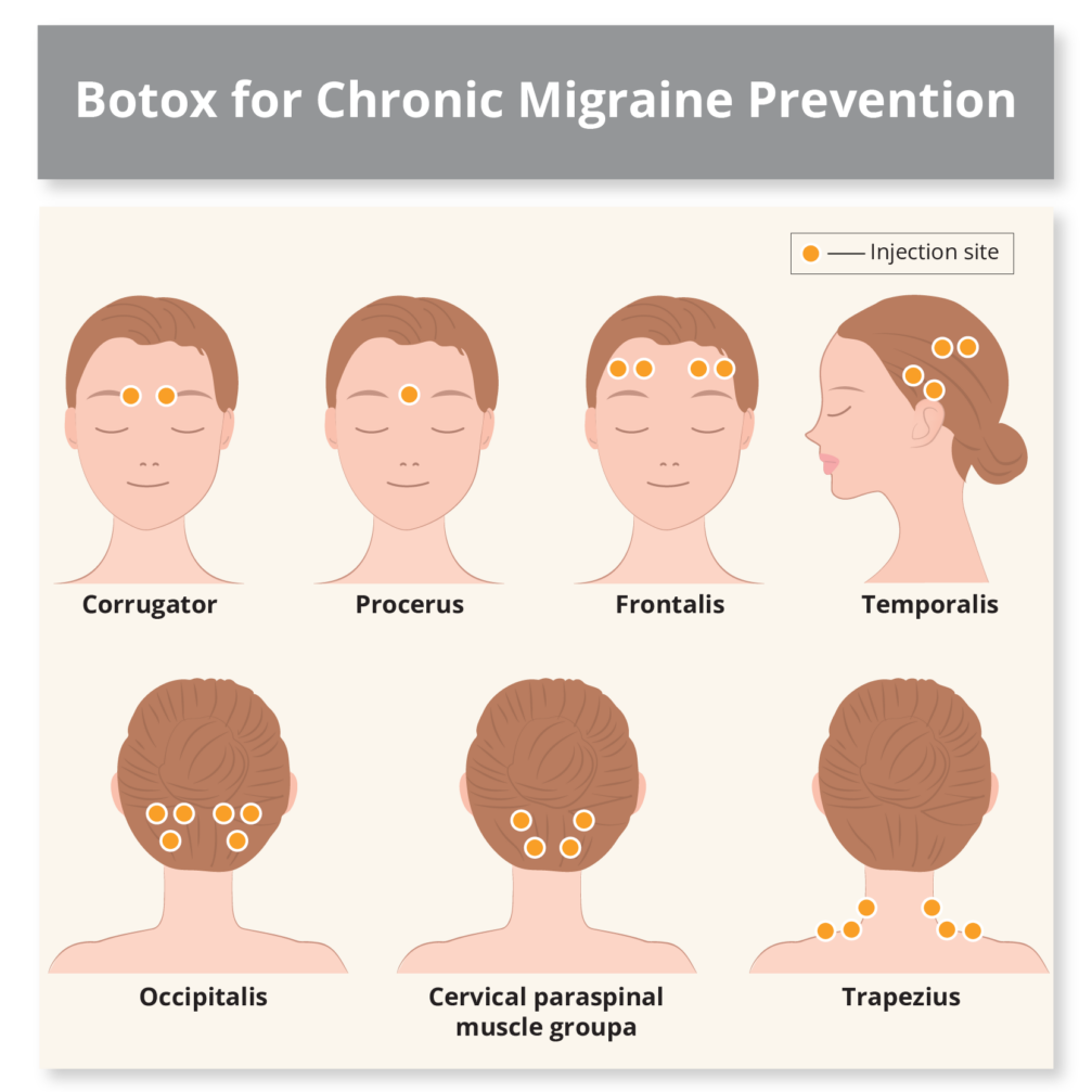 Migraine Treatment - MY TIMELESS